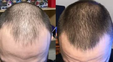 When do we see positive results? finasteride, minoxidil & microneedling | WRassman,M.D. BaldingBlog