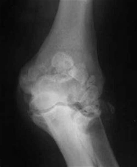 Classically, charcot joints in the lower limb were most often the result of tabes dorsalis but that is much. Neuropathic (Charcot) Joint of Shoulder & Elbow - Basic ...