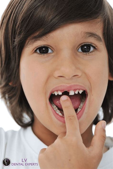 Therefore, rinse your mouth well after each meal. Best tips to painlessly pull a loose tooth. | Loose tooth ...