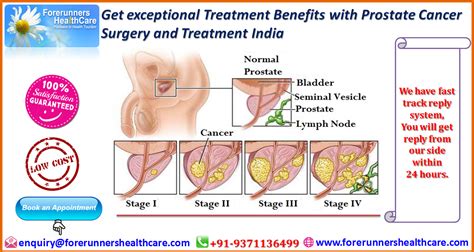 Please refresh the page and try again. Get exceptional Treatment Benefits with Prostate Cancer ...