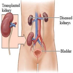 Check spelling or type a new query. How Much Does Kidney Removal Surgery Cost - kidneyoi