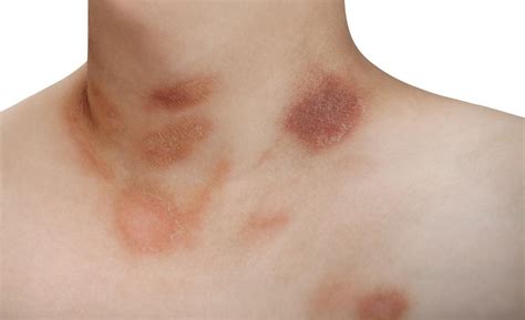 It's possible that the rash could be something other than pityriasis rosea. Pityriasis Rosea - Auckland Skin Clinic