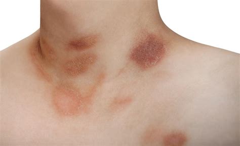 Pityriasis rosea is a mild, but common, skin condition. Pityriasis Rosea - Auckland Skin Clinic