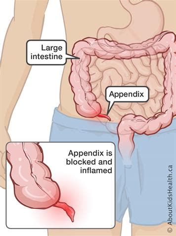 The appendix can become infected with bacteria or a virus. Appendicitis