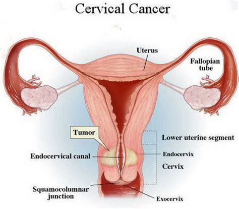‍ ‍when talking about cervical cancer, early diagnosis is extremely important for effective treatment. Cervical Cancer - Physiopedia
