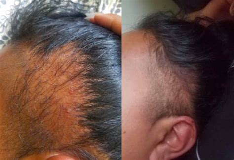 Studies have shown that biotin levels don't differ between people with and without hair loss. This Biotin Shampoo's Before And After Photos Will Have ...