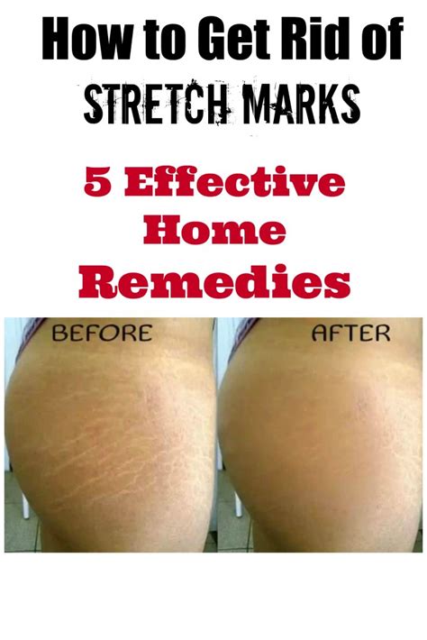 Men will notice a much more limited selection of brands, typically only one or two (such as just for men or clairol's men's choice). How to Get Rid of Stretch Marks: 5 Effective Home Remedies