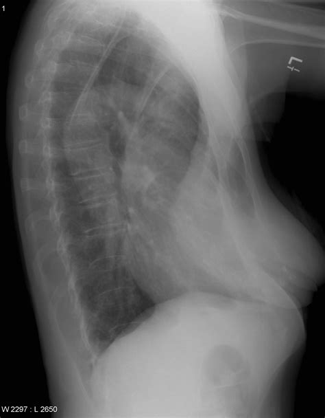Guys do you think i have pectus excavatum or rib flare? · r/pectusexcavatum. Pectus excavatum | Image | Radiopaedia.org