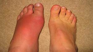 Gout in Pictures - Experiments on Battling Gout Gout  