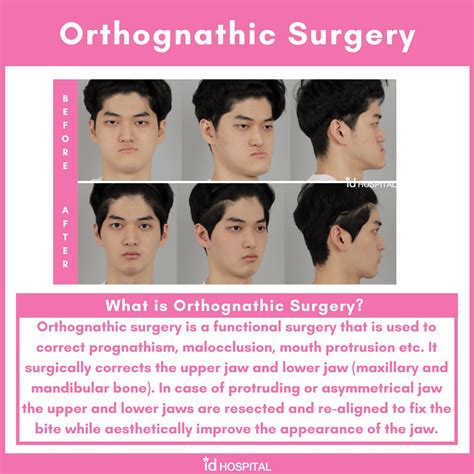 Orthognathic surgery at ID Hospital | Orthognathic surgery, Double jaw surgery, Jaw surgery