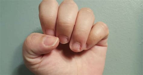 Oct 11, 2018 · increased pain or throbbing in finger; How To Get Rid Of Hangnails And Prevent Them From ...