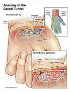 The carpal tunnel is a narrow passageway on the palm side of your wrist made up of bones and ligaments. Carpal Tunnel Syndrome Medical Illustration Exhibits ...
