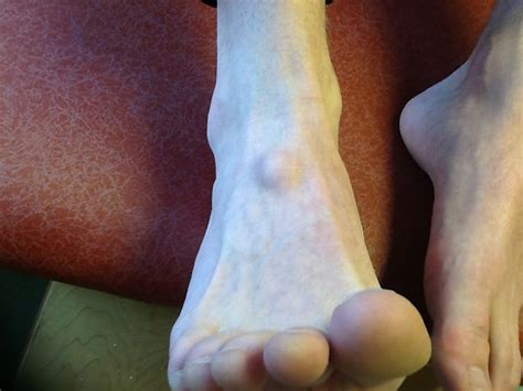 Patients are able to go home after a. Foot and Ankle Problems By Dr. Richard Blake: Ganglion Cysts