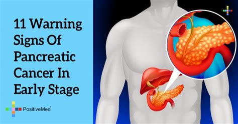Nausea and vomiting are two different symptoms that are present in many advanced diseases, including liver cancer. 11 Warning Signs Of Pancreatic Cancer In Early Stage