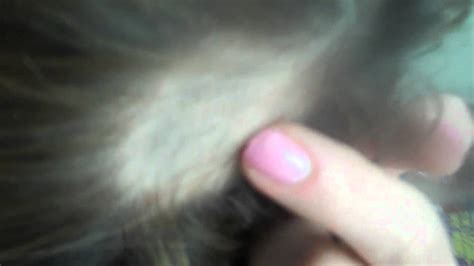 Scratching can make hair loss worse. Alopecia Areata Hair Loss Patchy Bald Spots - YouTube