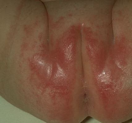 The most common areas affected include larger skin. candida intertrigo | Medical Pictures Info - Health ...