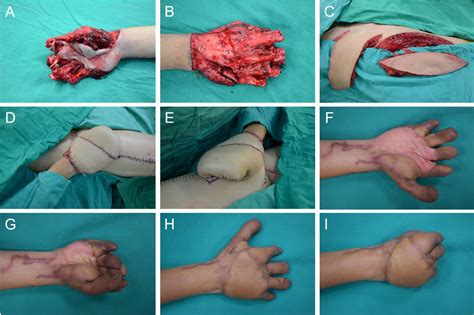 Sandwich Flap Reconstruction for a Degloving Hand Injury - SciTeMed ...