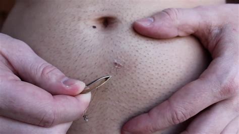 To each their own, right? Longest ingrown hair removal below belly button - YouTube