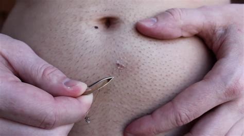 But dermatologists say they can be prevented if you tweak your routine when you shave or wax. Ingrown Hair Removal Videos Are The Newest Extraction ...