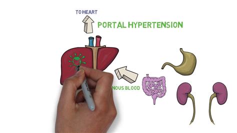 Liver cirrhosis is the most common cause. Pin on pathophysiology