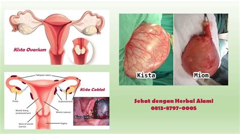 Khasiat daun sirsak untuk penyakit benjolan di payudara sebelah kiri :: Jual Obat Kista Alami