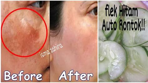 Jika kamu sedang bermasalah dengan jerawat, kamu bisa membuat masker kunyit untuk. CARA MENGHILANGKAN FLEK HITAM SECARA ALAMI DAN CEPAT - YouTube