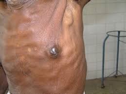 Early symptoms of cancer in men. Male breast cancer