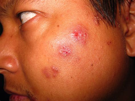 Éstos incluyen medicamentos anti herpes y varias clases de tratamientos para dolor. Shingles Lesions (Varicella Zoster, Trigeminal/Mandibular ...