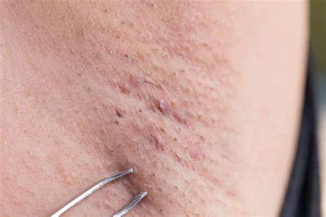 Ingrown armpit hairs may have various appearances. Pin on Natural Remedies