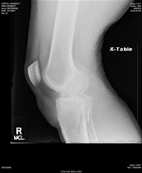 Tibial Plateau Fracture Recovery - Page 73