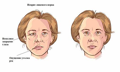 Диета лицевого неврита Инсульт нерва глазного нерва что это такое - фото презентация Инсульт нерва глазного нерва что это такое - фото презентация Диета лицевого неврита
