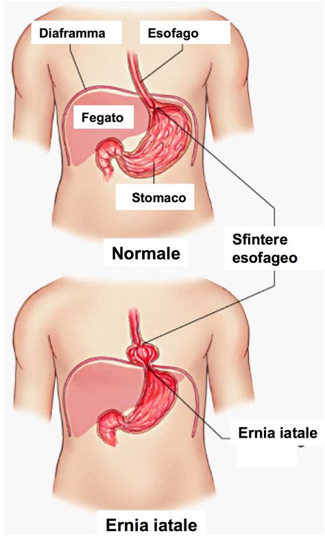 Se avete l'ernia iatale, l'apertura dello iato (dove l'esofago passa attraverso il diaframma) è più larga del normale. Ernia iatale - Endoscopiadigestiva.it di Felice Cosentino ...