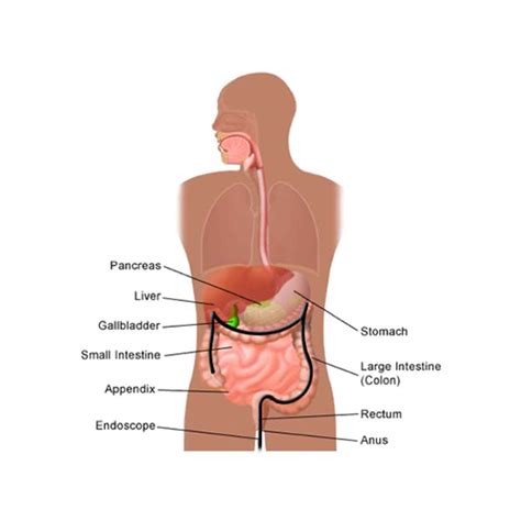 Hernia after colorectal cancer surgery: COLONOSCOPY - Specialist Surgeons