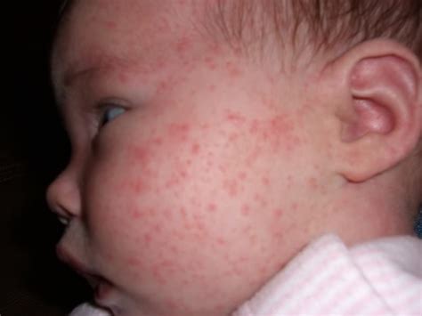 Acidic foods are known to cause diaper rash in some babies. Allergy in infants and pimples on face child - what to do ...