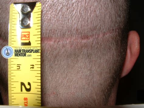 Hair transplant has turned into a multi disciplinary field that branches out into many different specialties. Hair Transplant Repair Cost