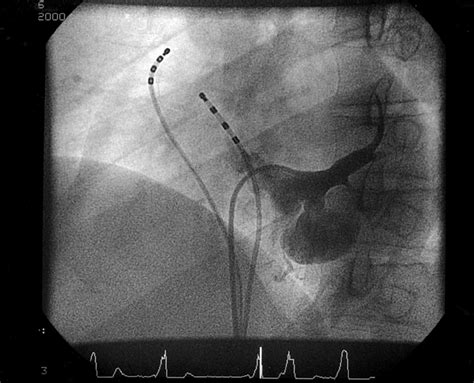 The posterior sinus of the aortic valve contains no coronary ostium and is often designated as the noncoronary sinus. Coronary sinus diverticulum containing posteroseptal ...