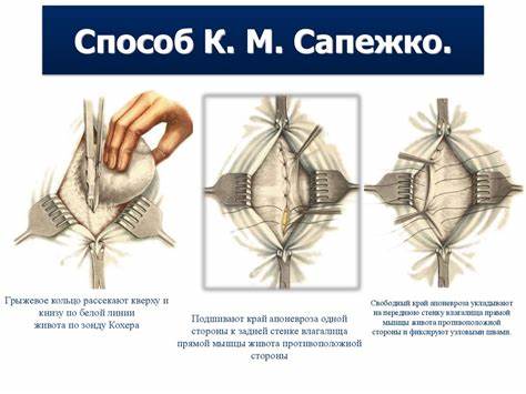 Диета и лечение грыжи пищевода Классические методики оперативного лечения грыж передней брюшной стенки Классические методики оперативного лечения грыж передней брюшной стенки Диета и лечение грыжи пищевода