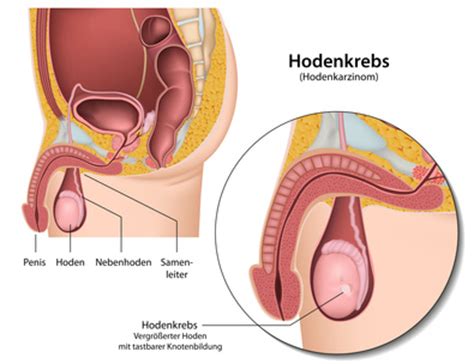 An der unterseite der eichel ist die vorhaut durch das vorhautbändchen (frenulum) an der eichel befestigt. Hodenkrebs - Hodenkarzinom | CityPraxen Berlin