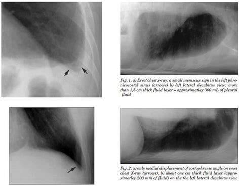 This position is called lateral decubitus position. Chest X-ray - Pleural Effusion | Epomedicine