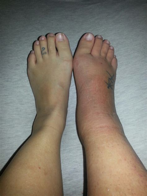 6 health specialists are standing by to help you right now. My Broken Ankle =(: Day 4 - Very swollen and red