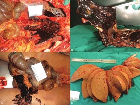 Pleural plaques and calcifications may be seen, suggesting history of asbestos exposure. (A) Bilateral pleural effusion of brownish material. (B ...