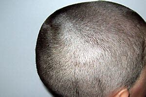 School shaves head-lice pupil - news - the-press | Stuff.co.nz