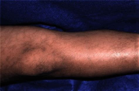 A genetic disorder is a condition that occurs as a result of a mutation in dna. Incontinentia pigmenti: MedlinePlus Genetics