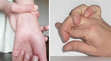 Что такое maladie de marfan inversée? Si vous pouvez faire ça avec vos mains, vous pourriez ...