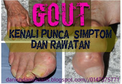 Dikongsikan juga penawar sakit gout. 3D health beauty supplement: KENALI TANDA, KOMPLIKASI DAN ...