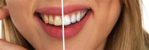 Cara yang paling cepat adalah pergi ke dokter gigi agar karang yang melekat pada gigi anda di bersihkan. Cara Memutihkan Gigi Kuning dengan Bahan-bahan Alami