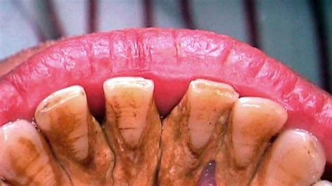 Untuk mengatasinya, selain pergi ke dokter gigi, cara menghilangkan karang gigi secara alami. Cara Hilangkan Karang Gigi Pakai Bahan yang Ada di Rumah ...