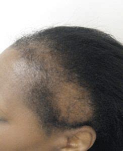 It can also happen during or after a viral illness. Edge Control - How to Combat Hairline Damage - Voice of Hair