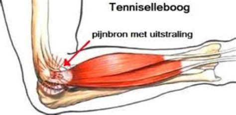 Kurzfassung der tennisarm ist ein lokal begrenztes schmerzsyndrom an der außenseite des die ursachen für einen tennisarm sind vielfältig. Tennisarm / Tenniselleboog Brace Kopen | #5 Tips - ProBrace