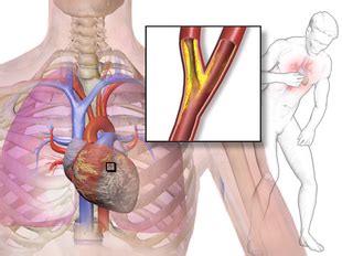 Ini menjadi keprihatinan tambahan apa hubungan sakit perut sebelah kiri dengan bagian aneurisma aorta perut? Laporan Pendahuluan Angina Pektoris (KMB) | Ala Nurse